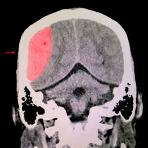 A CT scan of a TBI patient 