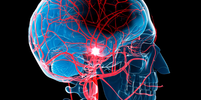 A 3D illustration of the human brain, highlighting the parts affected during a stroke