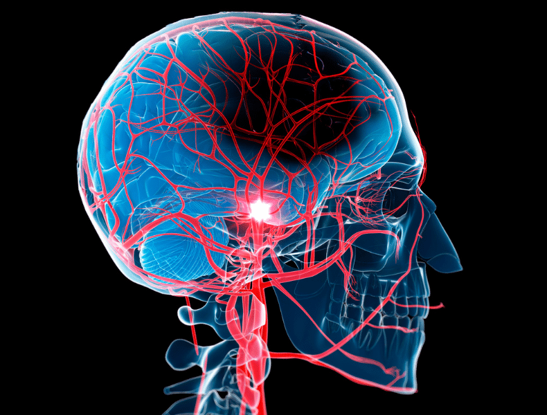 A 3D illustration of the human brain, highlighting the parts affected during a stroke